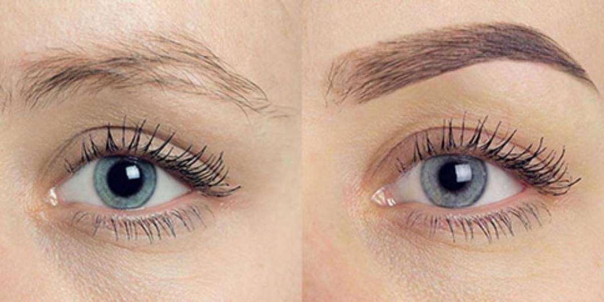 Eyebrow Transplant Before And After