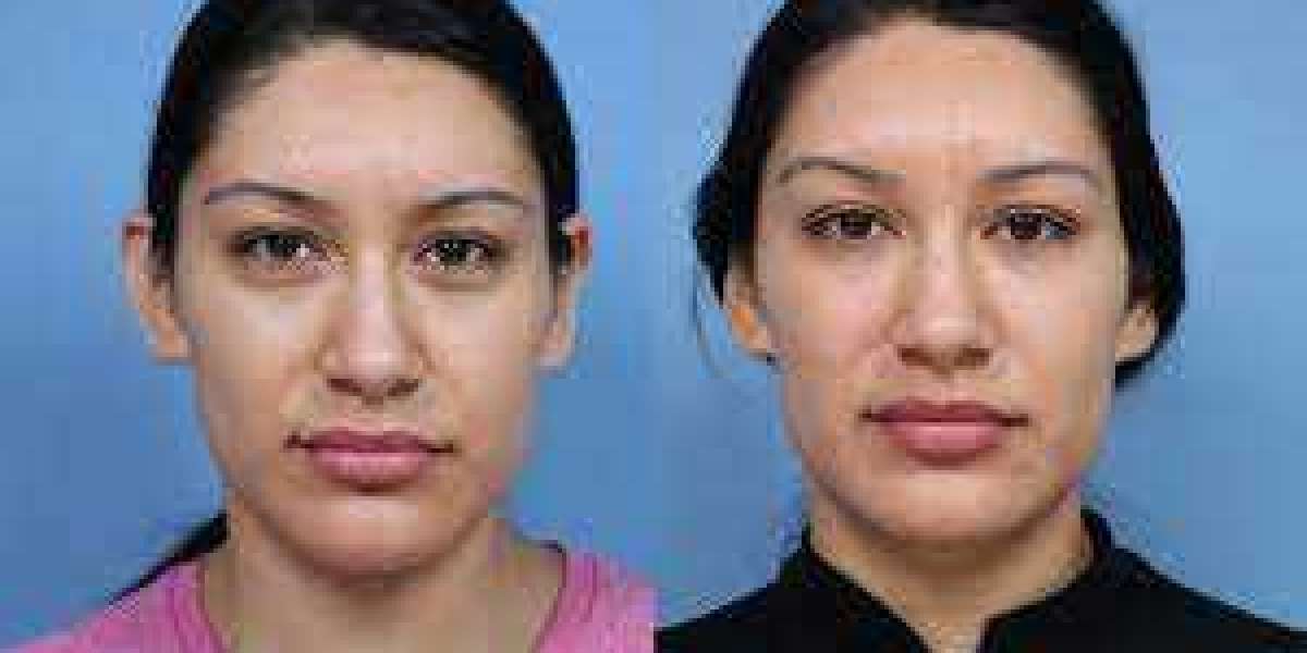 Face Fillers Before And After