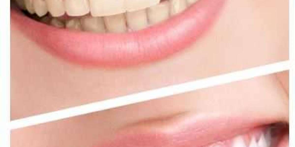What Is The Most Effective Whitening Method?