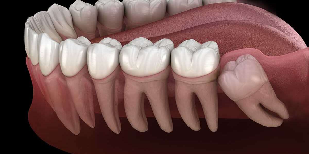 Why Experts Now Say Not To Remove Your Wisdom Teeth
