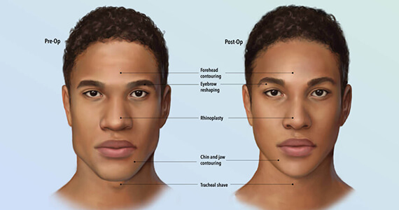 Facial Feminization Surgery – Dr Saroj K Sheoran