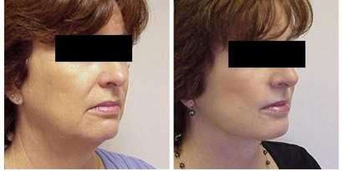 Facelift surgery - Everything You Need to Know