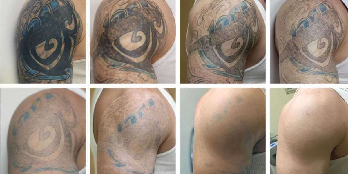 Tattoo Removal Market Research: Include Steep Growth in the Development of The Industry