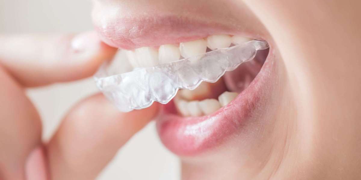 The Ultimate Guide to Braces Treatment and Invisible Braces in Bhopal