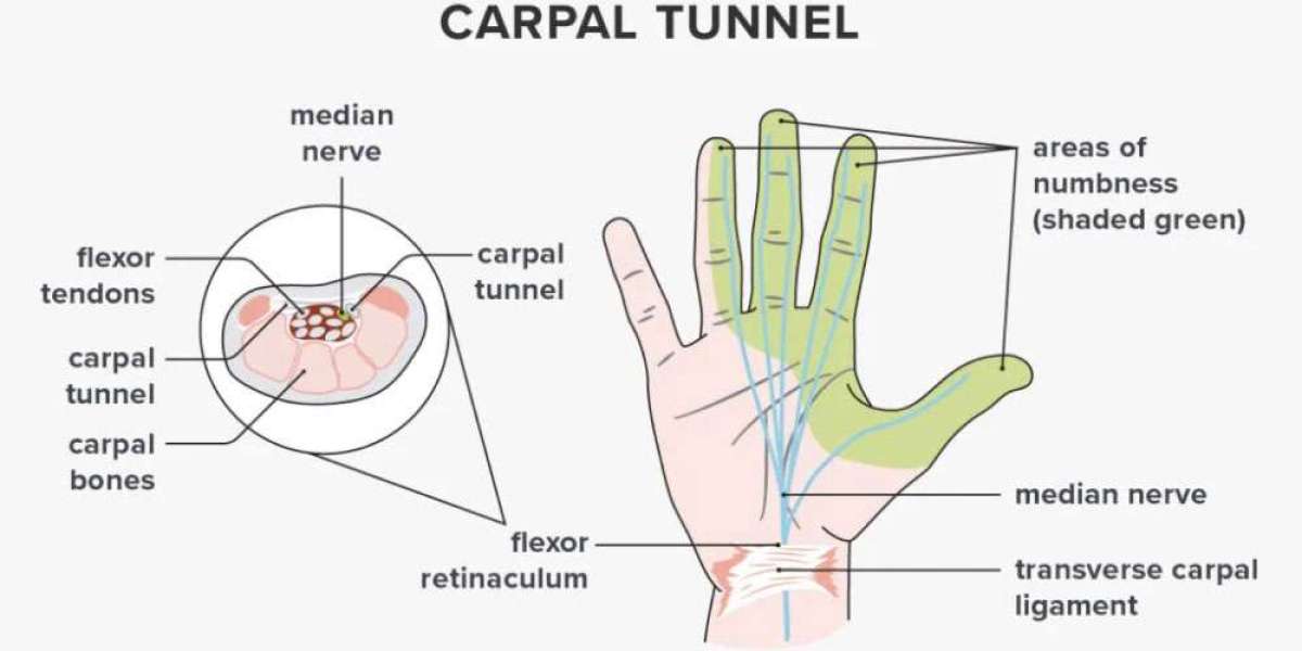Decoding Infection: Understanding Its Role in Carpal Tunnel Syndrome | DLI