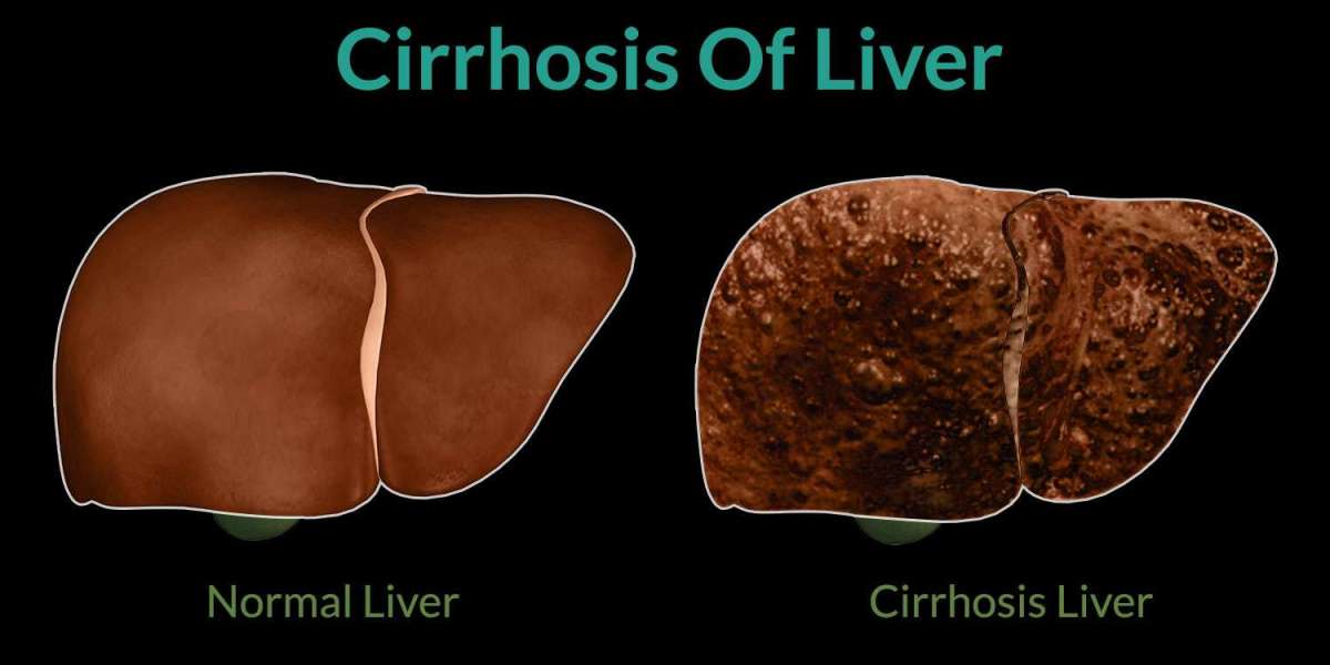Cirrhosis Disease: Shaping Future Trends in Treatment Markets | DLI