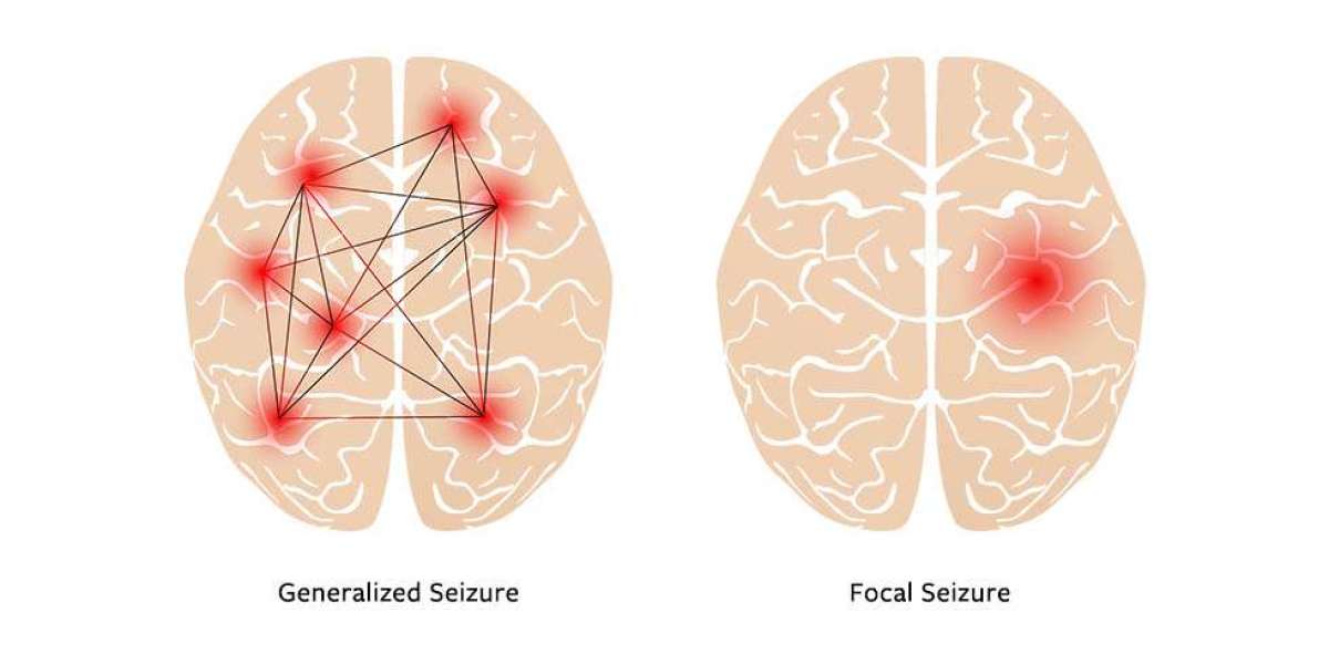 Focal (Partial) Epilepsy: Understanding and Managing Seizure Disorders