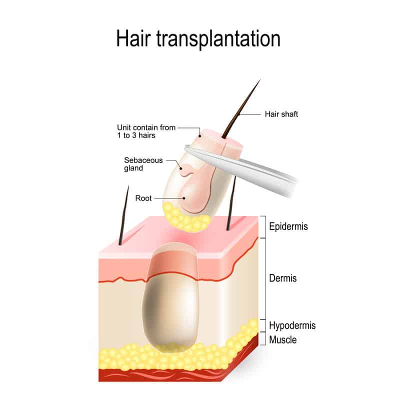 Hair Transplantation Raleigh, NC - FUE Treatment Raleigh, NC