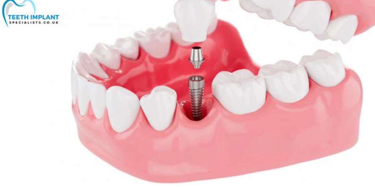 Unveiling the Art and Science of Dental Implants in the UK: A Comprehensive Guide
