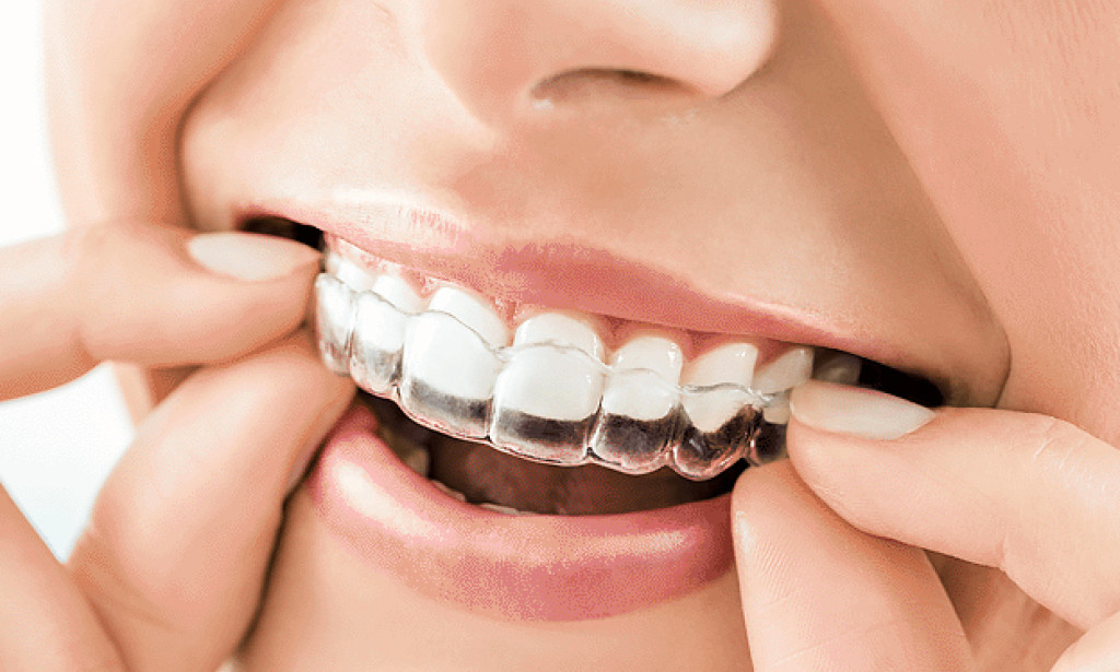 When to Expect Results: The Timeline of Invisalign Treatment