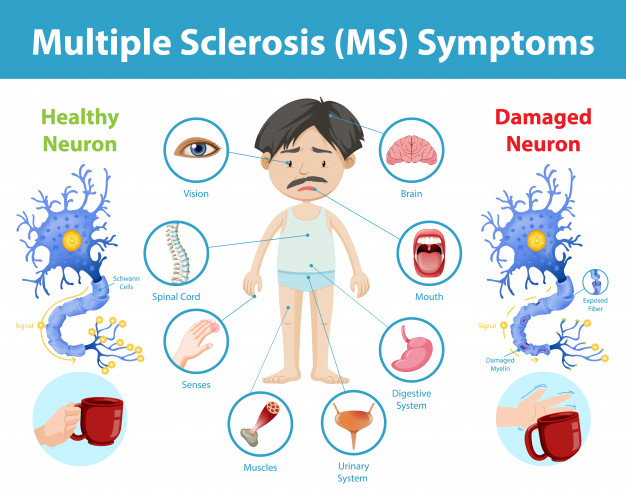 Whizolosophy | Unveiling the Signs: Symptoms of MS in Women