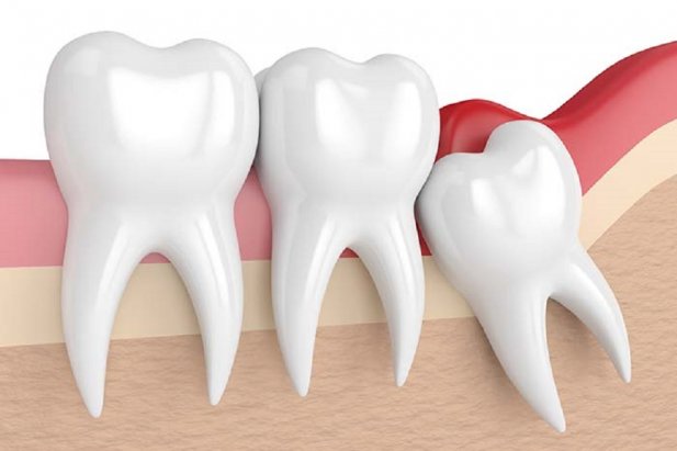 Can wisdom tooth removal prevent future dental problems?