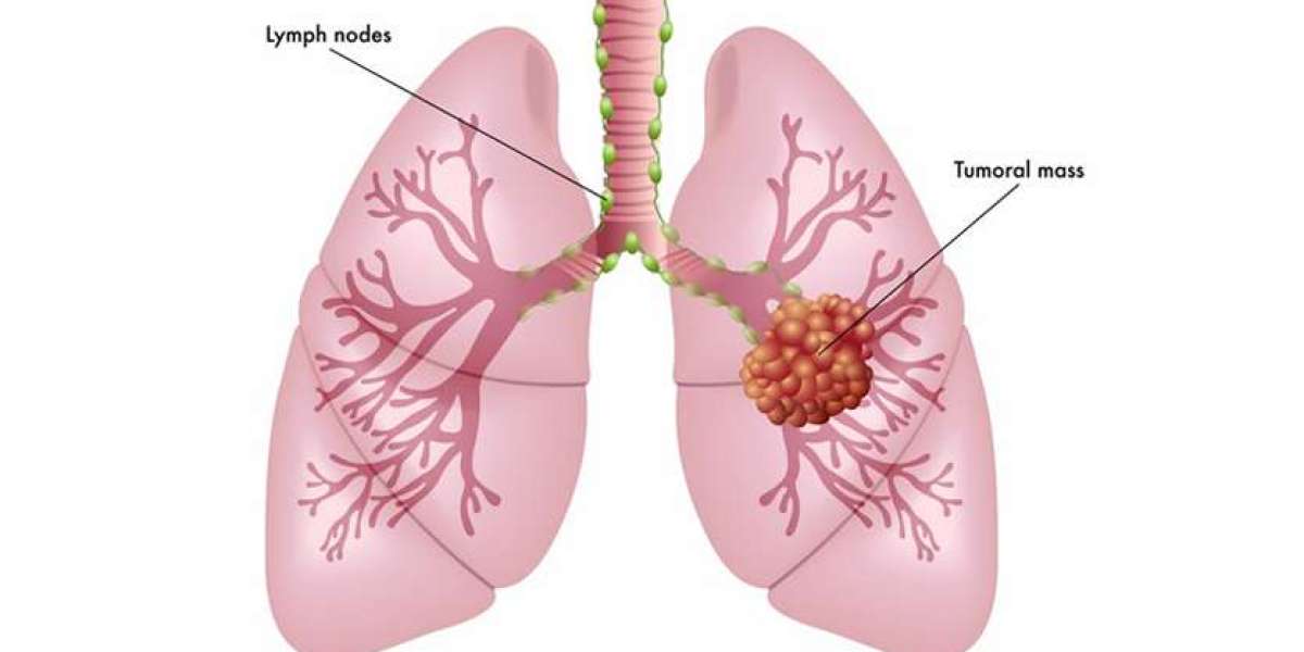 Lungs transplant in India