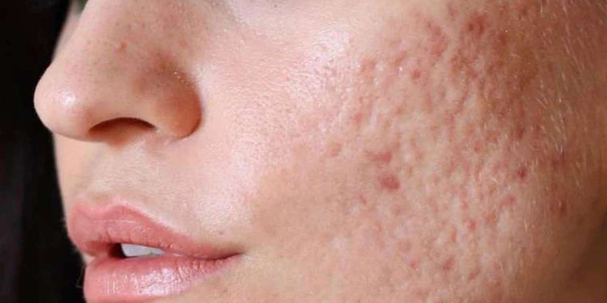 Acne Scar Treatments for Darker Skin Tones