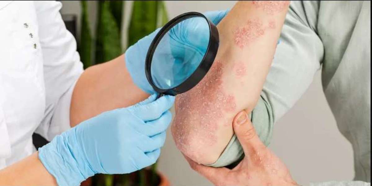Home Remedies For Psoriasis Treatment
