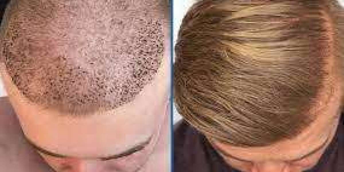 Hair Restoration in Dubai UAE At Royal Clinic |  Royal Clinic