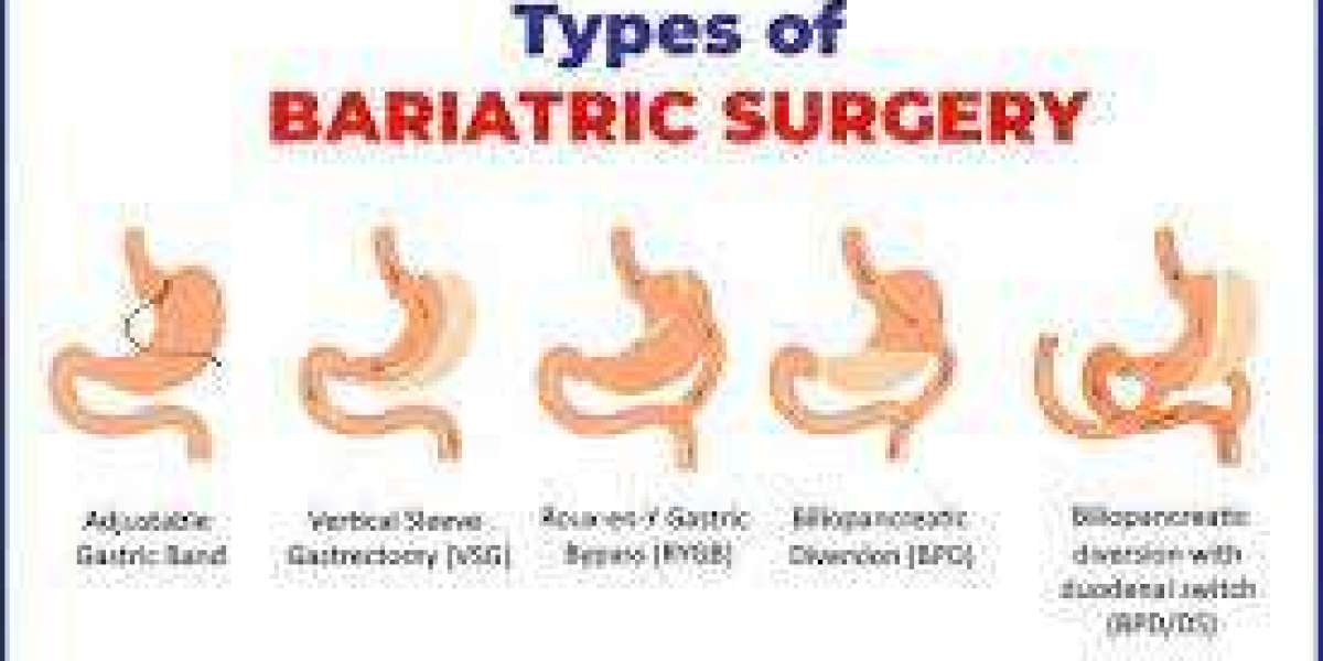 Bariatric Surgery In Gurgaon