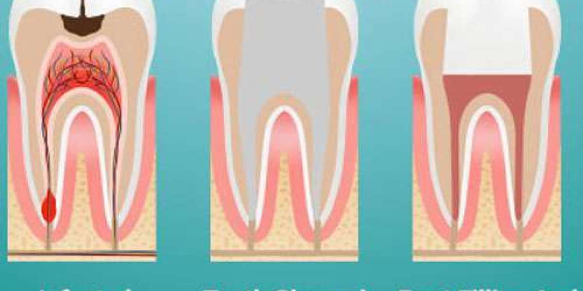 Laser root canal treatment in Delhi