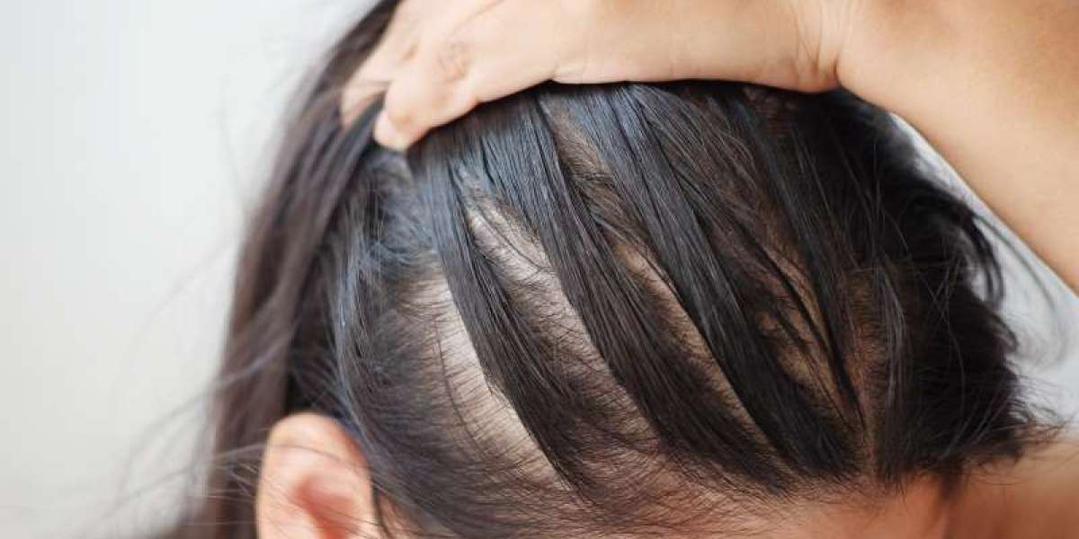 Hair Loss Myths vs. Facts for Women: Debunking Common Misconceptions