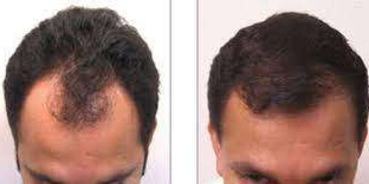 Hair Restoration Dubai UAE At Royal Clinic ?
