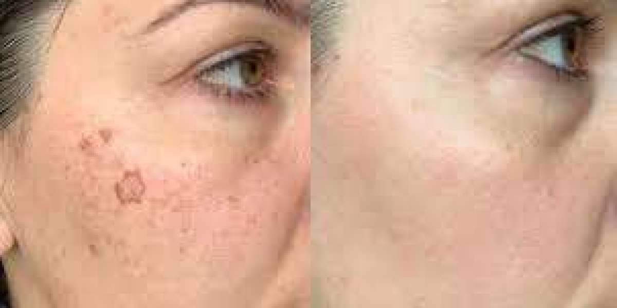 Pigmentation Treatment: What You Need to Know