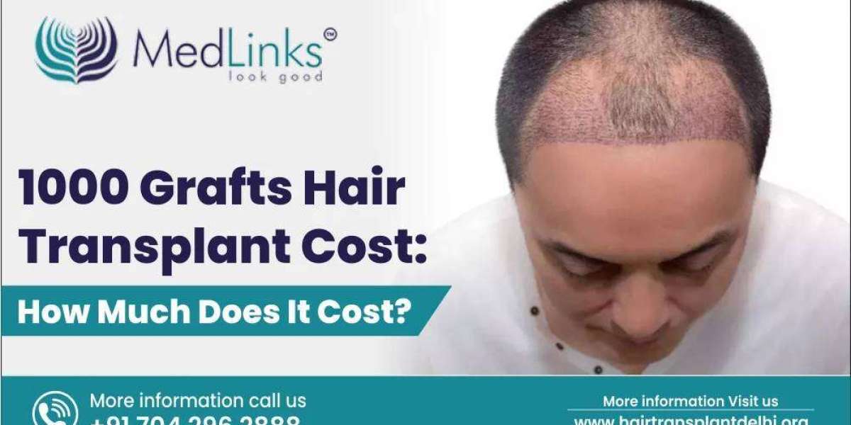 1000 Grafts Hair Transplant Cost: How Much Does It Cost?