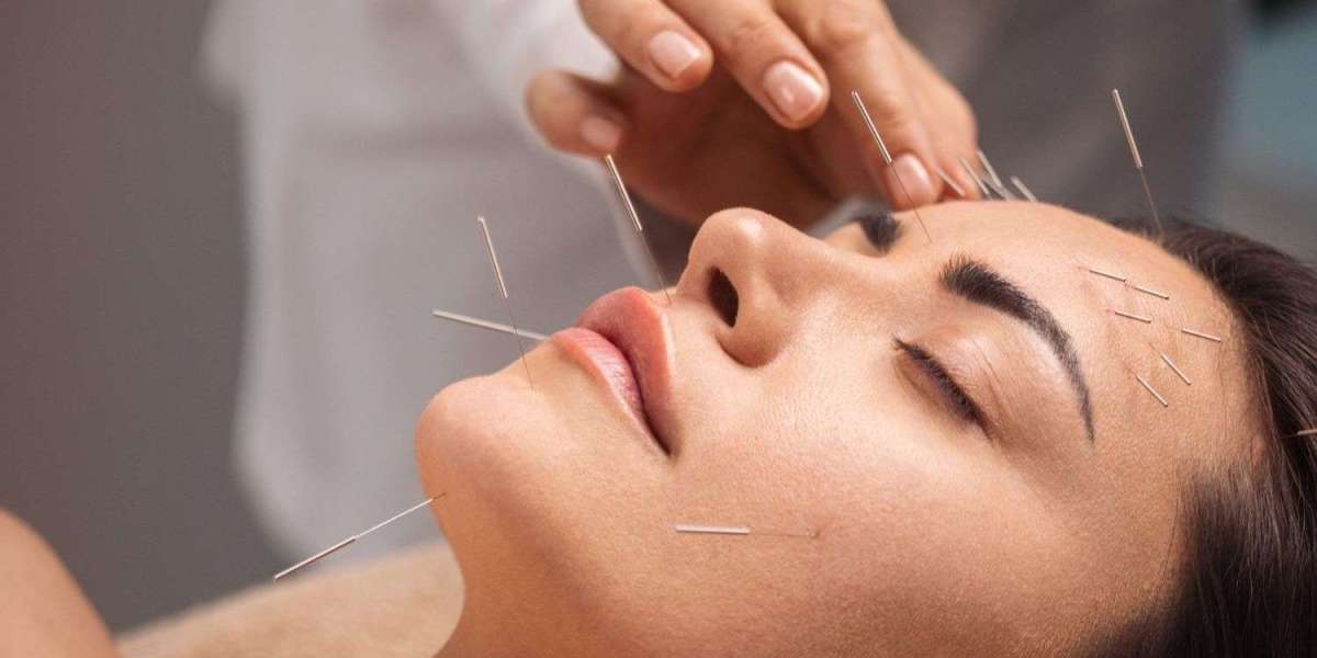 Insider Tips for Choosing the Best Acupuncturist