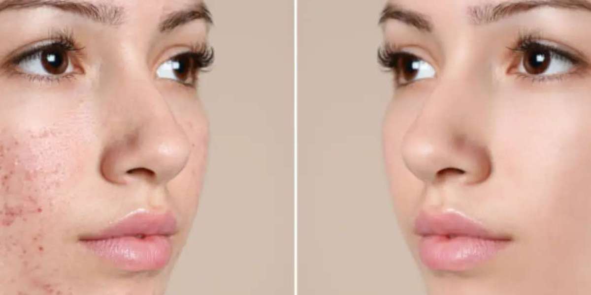 Achieving Clear Skin: Remedial Steps For Acne Scar Removal