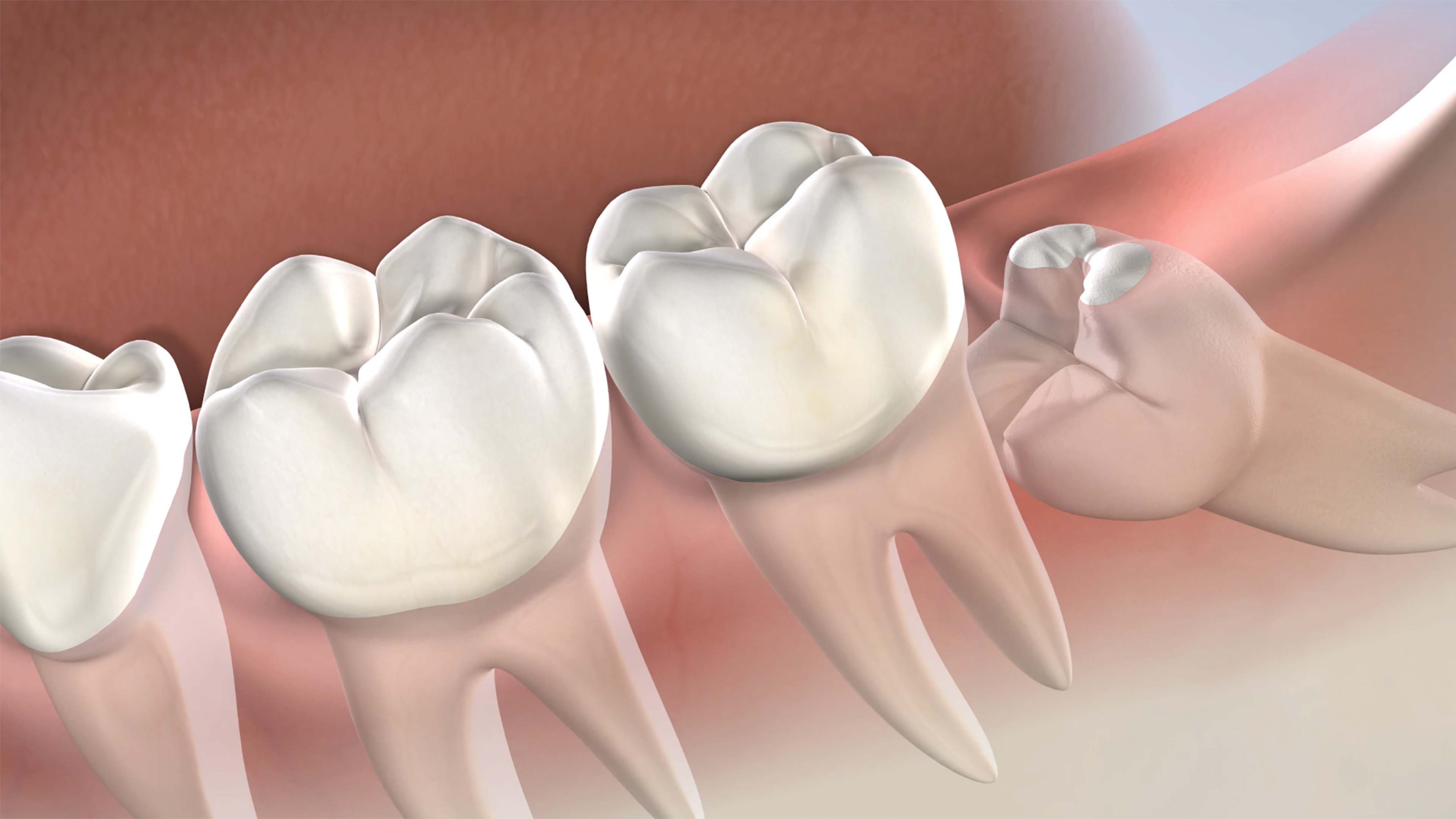 Facts to Know About Wisdom Tooth Removal – Telegraph