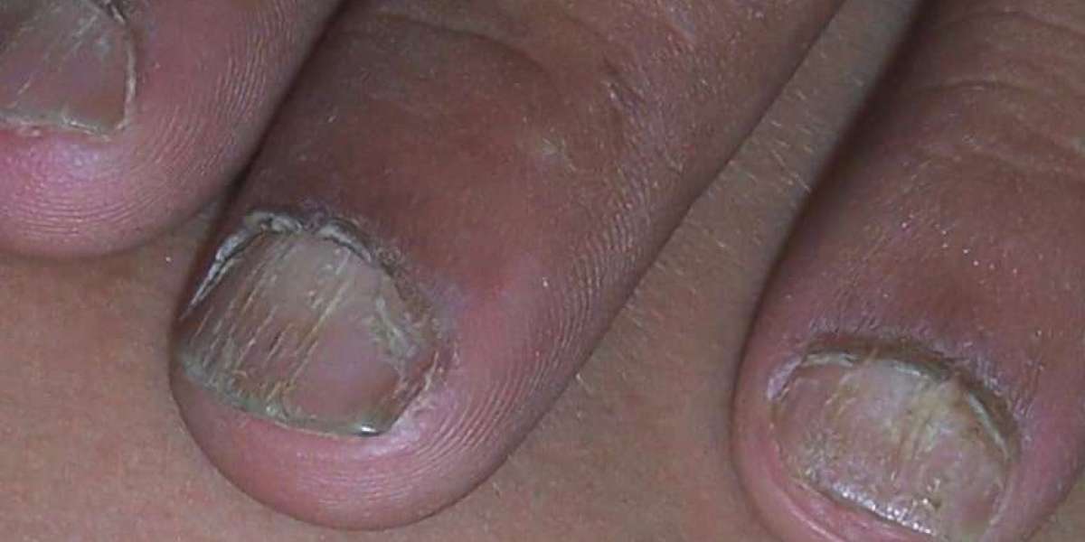 Why is ingrown toenail removal essential?