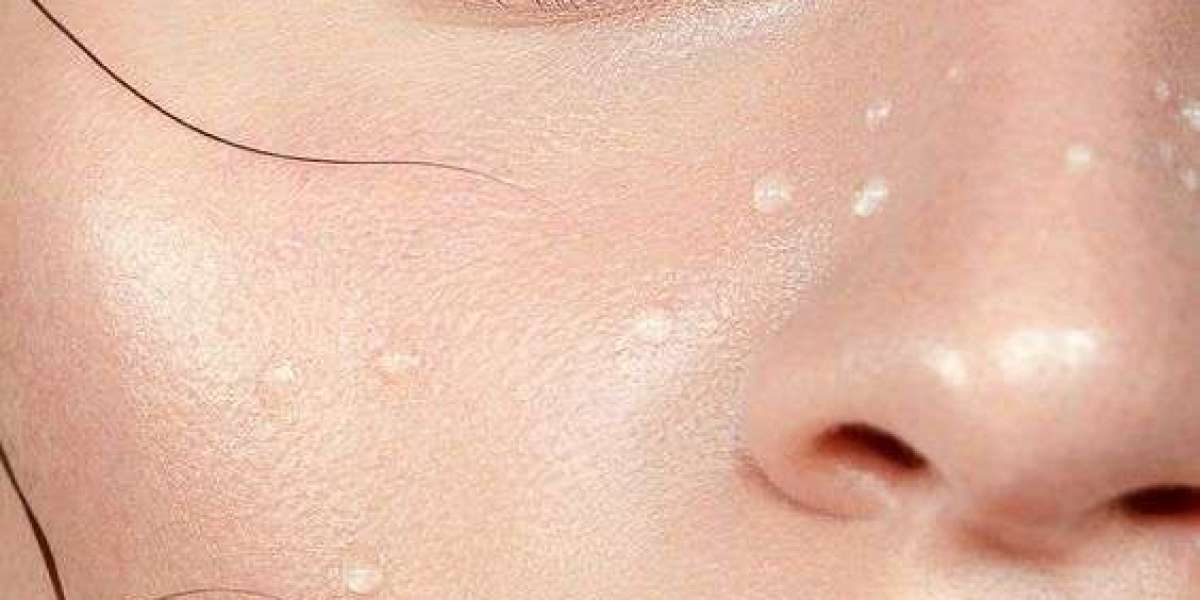 How to Get Rid of Dark Circles Fast: 5 Easy Tips