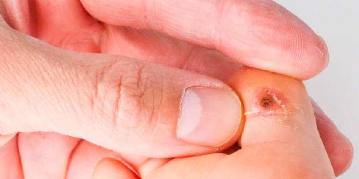 Wart Treatment Toolbox: Options and Considerations