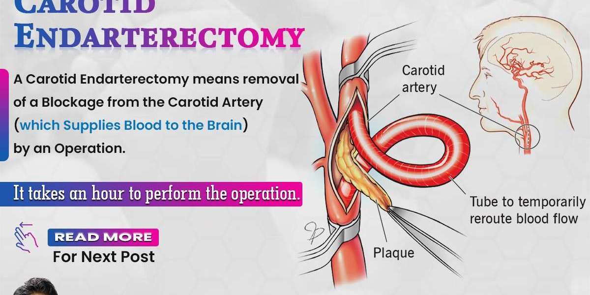 what is Carotid endarterectomy