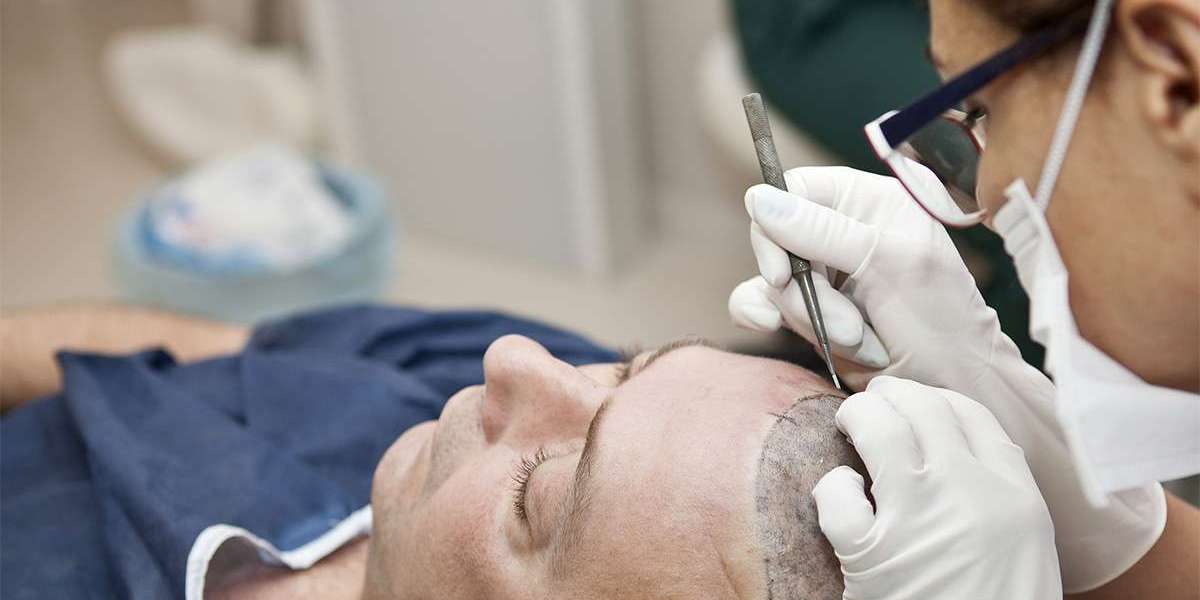 A New Era in Hair Restoration: Scalp Micropigmentation in Dubai