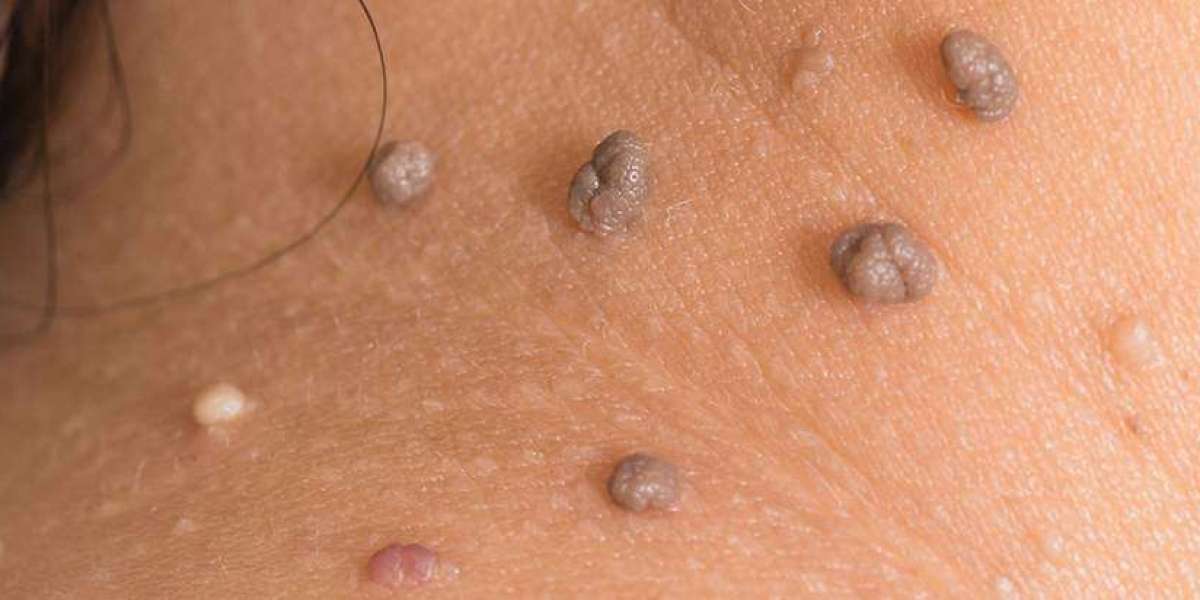 Mole Removal Treatment: A Comprehensive Overview