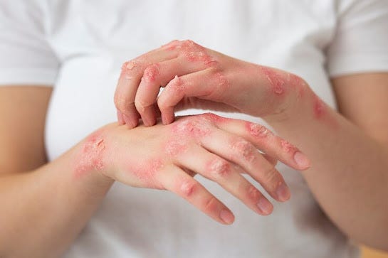 Strategies to Avoid Eczema Relapses | by Wise RX Card | May, 2024 | Medium