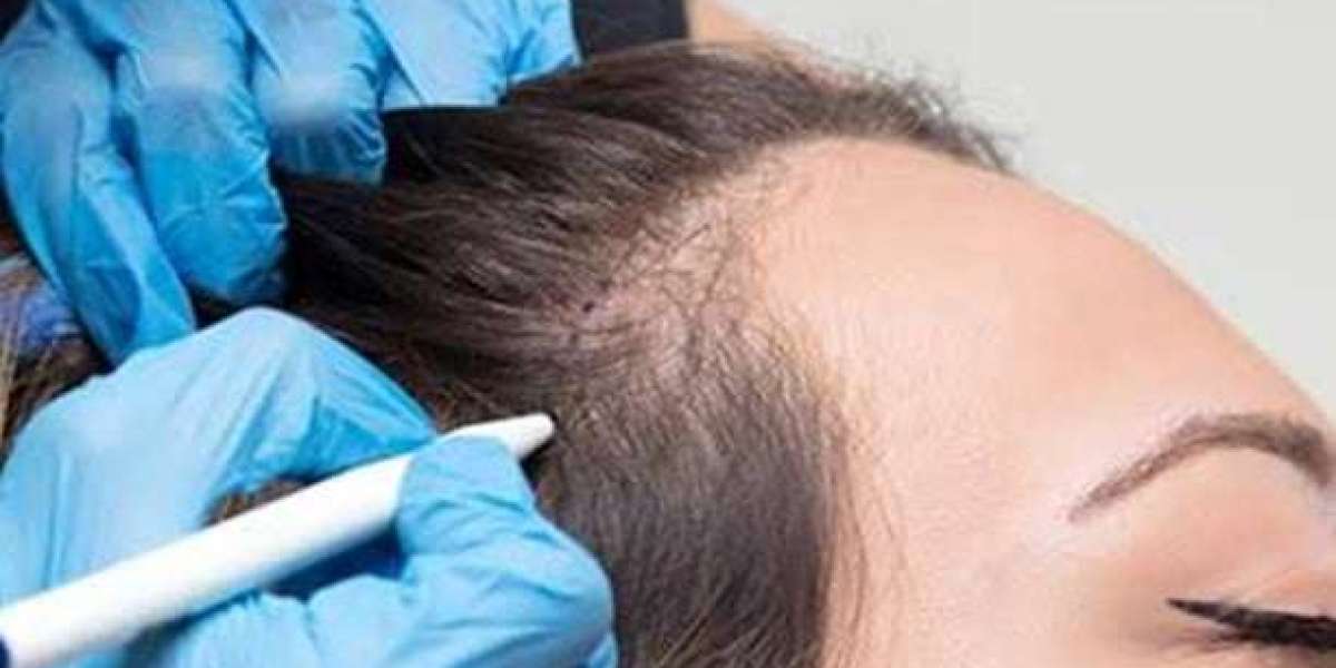 All You Need to Know About Hair Transplant Treatment in Abu Dhabi