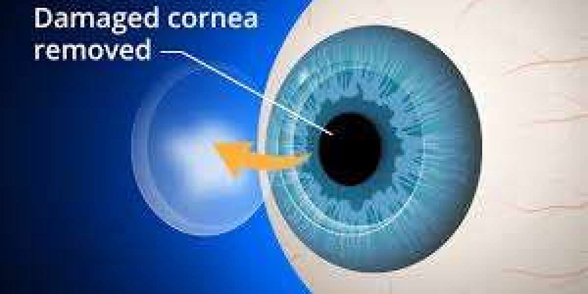 Corneal Transplant Market is Booming Worldwide to Show Significant Growth Over the Forecast to 2034