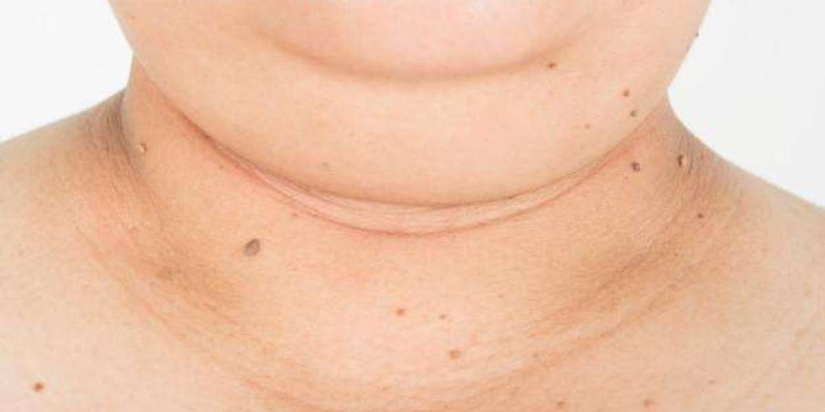 Double Chin: Is It Just a Cosmetic Concern?
