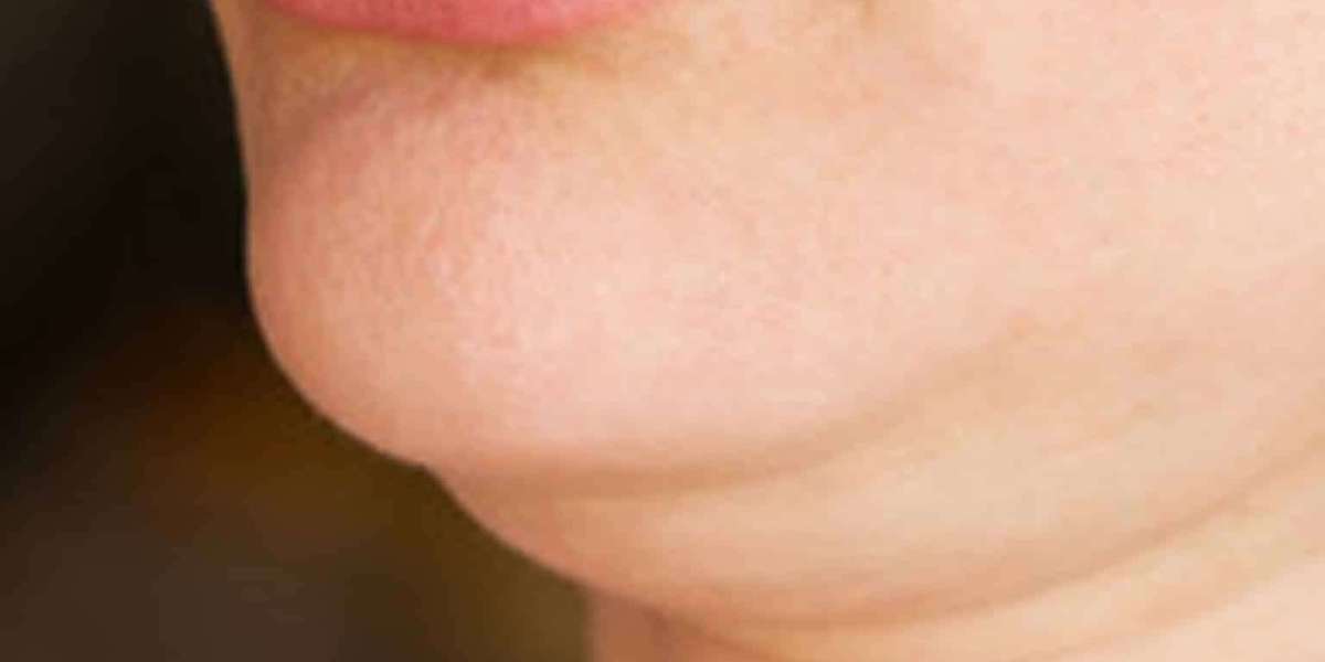Double Chin Solutions in Dubai: Say Goodbye to Sagging Skin