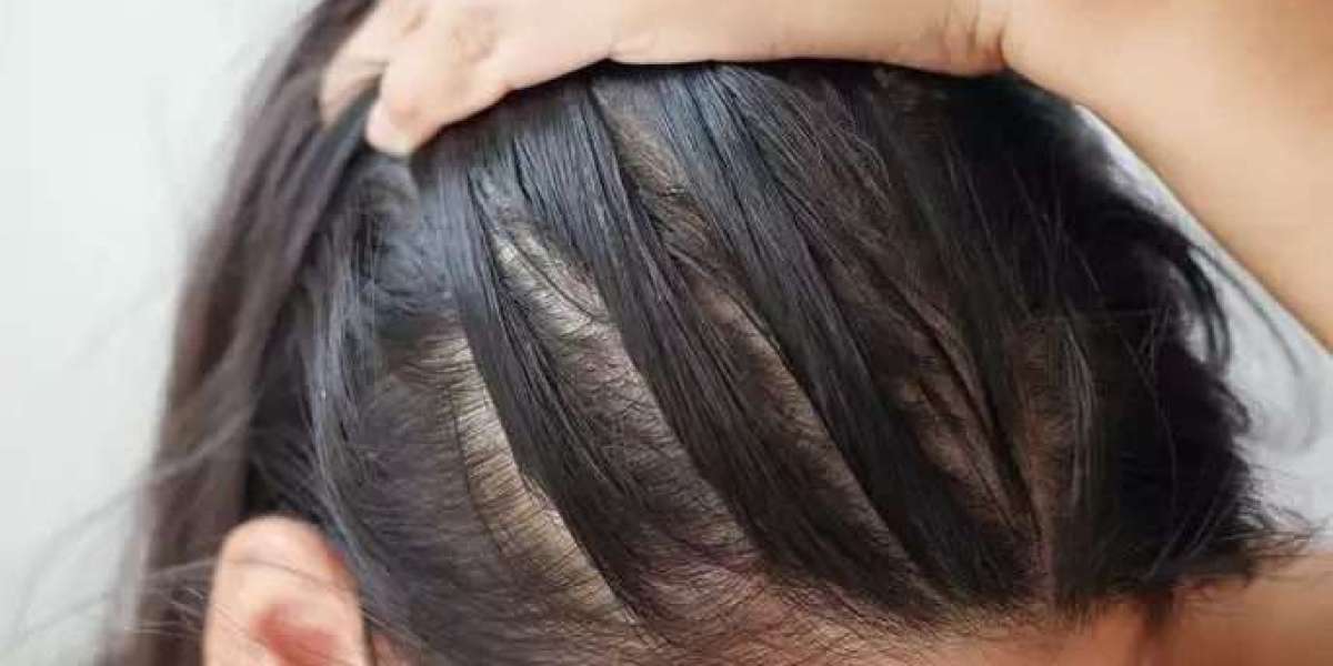 The Science of Perfect Hair: Scalp Micropigmentation in Dubai