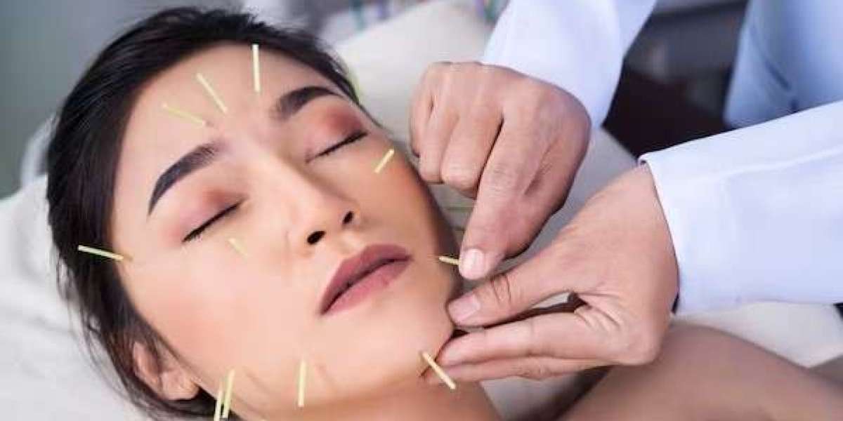 Unlock Timeless Radiance: The Power of Acupuncture Face Lift for Facial Rejuvenation