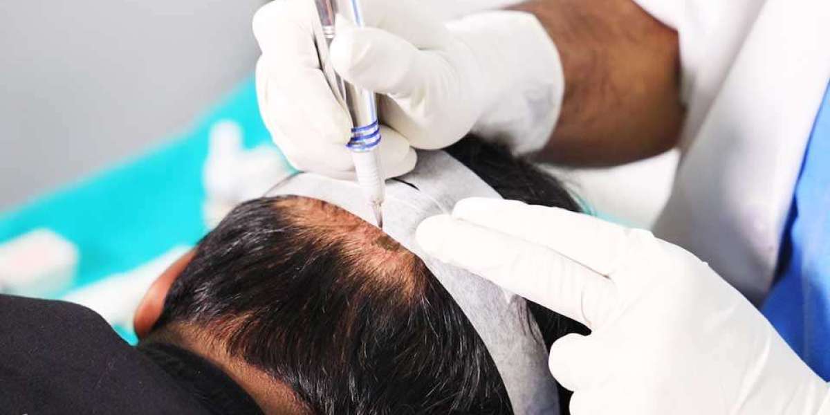Dubai's Hidden Gem: Scalp Micropigmentation Clinics