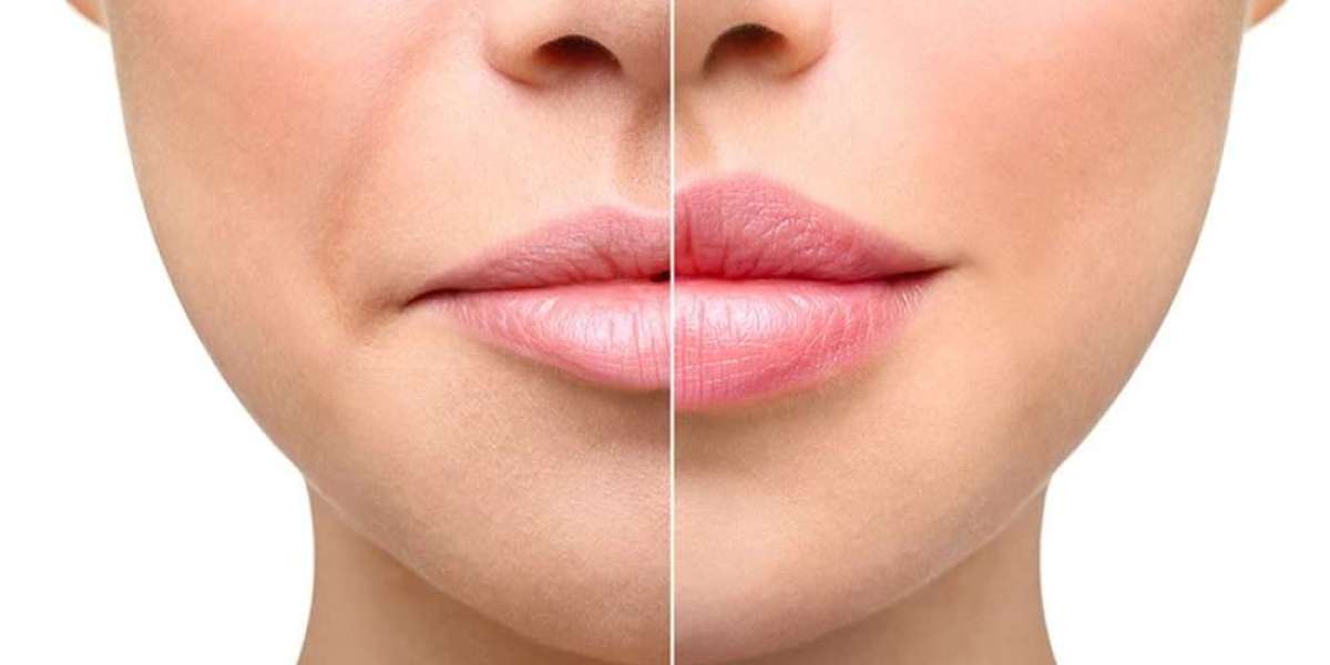 United States Dermal Fillers Market Size, Share, Forecasts to 2033