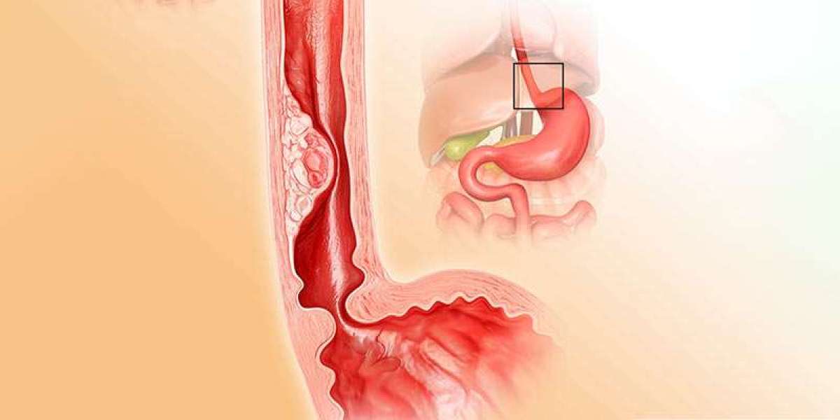 Gerd surgery cost in India