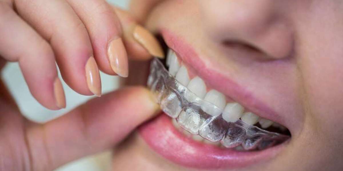 5 FAQs about Teeth Straightening With Invisalign