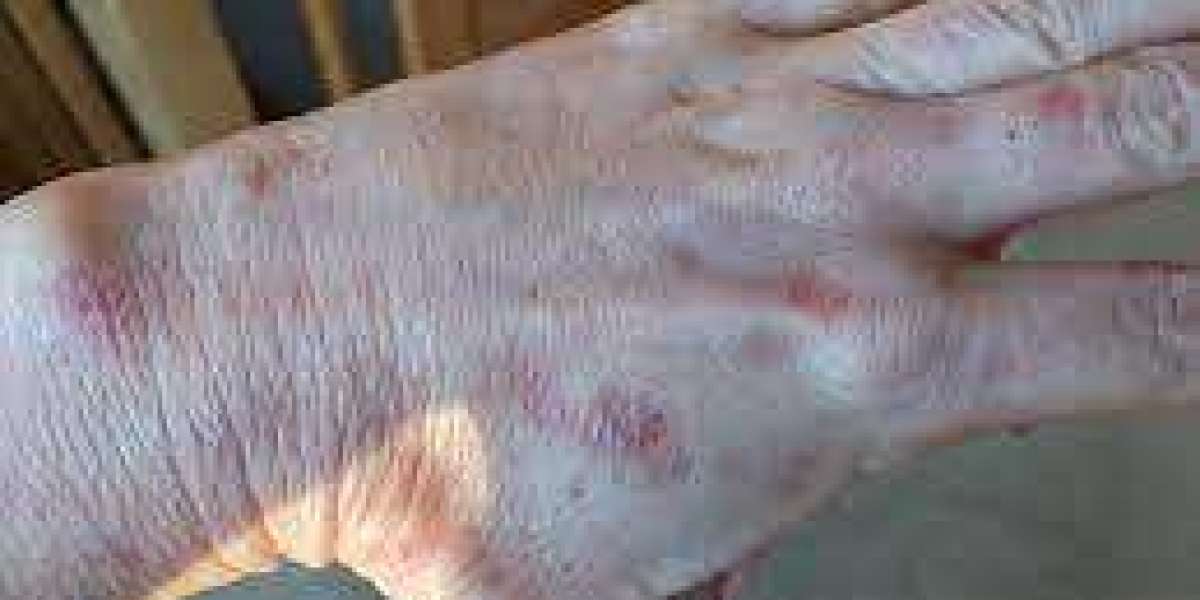 Actinic Keratosis on Hands: Real Stories from Patients